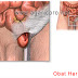 Obat Hernia Tradisonal Paling Paten Dalam Menaklukan Hernia